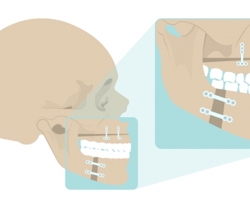 Çene - Yüz Ameliyatı (Ortognatik Cerrahi)